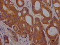 IHC image of CSB-RA280380A0HU diluted at 1:100 and staining in paraffin-embedded human colon cancer performed on a Leica BondTM system. After dewaxing and hydration, antigen retrieval was mediated by high pressure in a citrate buffer (pH 6.0) . Section was blocked with 10% normal goat serum 30min at RT. Then primary antibody (1% BSA) was incubated at 4℃ overnight. The primary is detected by a Goat anti-rabbit IgG polymer labeled by HRP and visualized using 0.05% DAB.