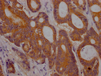 IHC image of CSB-RA280380A0HU diluted at 1:100 and staining in paraffin-embedded human colon cancer performed on a Leica BondTM system. After dewaxing and hydration, antigen retrieval was mediated by high pressure in a citrate buffer (pH 6.0) . Section was blocked with 10% normal goat serum 30min at RT. Then primary antibody (1% BSA) was incubated at 4℃ overnight. The primary is detected by a Goat anti-rabbit IgG polymer labeled by HRP and visualized using 0.05% DAB.