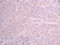 IHC image of CSB-RA283068A0HU diluted at 1:100 and staining in paraffin-embedded human liver cancer performed on a Leica BondTM system. After dewaxing and hydration, antigen retrieval was mediated by high pressure in a citrate buffer (pH 6.0) . Section was blocked with 10% normal goat serum 30min at RT. Then primary antibody (1% BSA) was incubated at 4°C overnight. The primary is detected by a Goat anti-rabbit polymer IgG labeled by HRP and visualized using 0.05% DAB.
