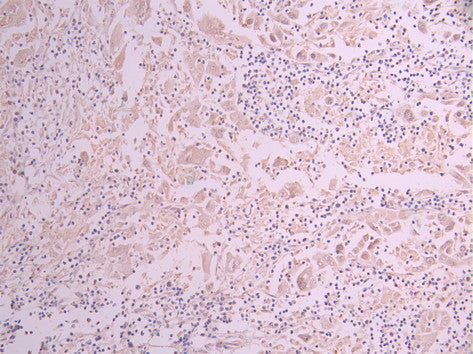 IHC image of CSB-RA283068A0HU diluted at 1:100 and staining in paraffin-embedded human liver cancer performed on a Leica BondTM system. After dewaxing and hydration, antigen retrieval was mediated by high pressure in a citrate buffer (pH 6.0) . Section was blocked with 10% normal goat serum 30min at RT. Then primary antibody (1% BSA) was incubated at 4°C overnight. The primary is detected by a Goat anti-rabbit polymer IgG labeled by HRP and visualized using 0.05% DAB.
