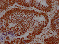 IHC image of CSB-RA289890A0HU diluted at 1:100 and staining in paraffin-embedded human ovarian cancer performed on a Leica BondTM system. After dewaxing and hydration, antigen retrieval was mediated by high pressure in a citrate buffer (pH 6.0) . Section was blocked with 10% normal goat serum 30min at RT. Then primary antibody (1% BSA) was incubated at 4℃ overnight. The primary is detected by a Goat anti-rabbit IgG polymer labeled by HRP and visualized using 0.05% DAB.
