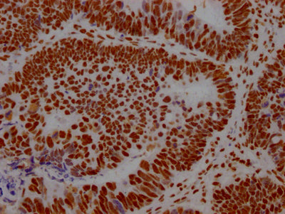 IHC image of CSB-RA289890A0HU diluted at 1:100 and staining in paraffin-embedded human ovarian cancer performed on a Leica BondTM system. After dewaxing and hydration, antigen retrieval was mediated by high pressure in a citrate buffer (pH 6.0) . Section was blocked with 10% normal goat serum 30min at RT. Then primary antibody (1% BSA) was incubated at 4℃ overnight. The primary is detected by a Goat anti-rabbit IgG polymer labeled by HRP and visualized using 0.05% DAB.