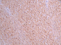IHC image of CSB-RA290314A0HU diluted at 1:100 and staining in paraffin-embedded human liver cancer performed on a Leica BondTM system. After dewaxing and hydration, antigen retrieval was mediated by high pressure in a citrate buffer (pH 6.0) . Section was blocked with 10% normal goat serum 30min at RT. Then primary antibody (1% BSA) was incubated at 4°C overnight. The primary is detected by a Goat anti-rabbit polymer IgG labeled by HRP and visualized using 0.05% DAB.