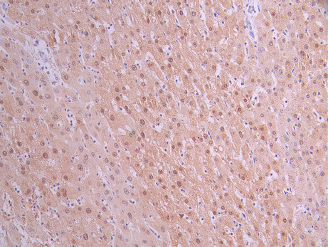 IHC image of CSB-RA290314A0HU diluted at 1:100 and staining in paraffin-embedded human liver cancer performed on a Leica BondTM system. After dewaxing and hydration, antigen retrieval was mediated by high pressure in a citrate buffer (pH 6.0) . Section was blocked with 10% normal goat serum 30min at RT. Then primary antibody (1% BSA) was incubated at 4°C overnight. The primary is detected by a Goat anti-rabbit polymer IgG labeled by HRP and visualized using 0.05% DAB.