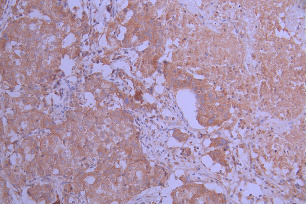 IHC image of CSB-RA292221A0HU diluted at 1:100 and staining in paraffin-embedded human breast cancer performed on a Leica BondTM system. After dewaxing and hydration, antigen retrieval was mediated by high pressure in a citrate buffer (pH 6.0) . Section was blocked with 10% normal goat serum 30min at RT. Then primary antibody (1% BSA) was incubated at 4°C overnight. The primary is detected by a Goat anti-rabbit polymer IgG labeled by HRP and visualized using 0.05% DAB.