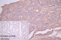 IHC image of CSB-RA293053A0HU diluted at 1:100 and staining in paraffin-embedded human colon cancer performed on a Leica BondTM system. After dewaxing and hydration, antigen retrieval was mediated by high pressure in a citrate buffer (pH 6.0) . Section was blocked with 10% normal goat serum 30min at RT. Then primary antibody (1% BSA) was incubated at 4°C overnight. The primary is detected by a Goat anti-rabbit polymer IgG labeled by HRP and visualized using 0.05% DAB.