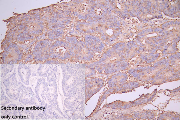 IHC image of CSB-RA293053A0HU diluted at 1:100 and staining in paraffin-embedded human colon cancer performed on a Leica BondTM system. After dewaxing and hydration, antigen retrieval was mediated by high pressure in a citrate buffer (pH 6.0) . Section was blocked with 10% normal goat serum 30min at RT. Then primary antibody (1% BSA) was incubated at 4°C overnight. The primary is detected by a Goat anti-rabbit polymer IgG labeled by HRP and visualized using 0.05% DAB.