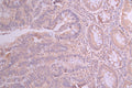 IHC image of CSB-RA295233A0HU diluted at 1:100 and staining in paraffin-embedded human colorectal cancer performed on a Leica BondTM system. After dewaxing and hydration, antigen retrieval was mediated by high pressure in a citrate buffer (pH 6.0) . Section was blocked with 10% normal goat serum 30min at RT. Then primary antibody (1% BSA) was incubated at 4°C overnight. The primary is detected by a Goat anti-rabbit polymer IgG labeled by HRP and visualized using 0.05% DAB.