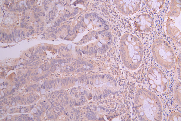 IHC image of CSB-RA295233A0HU diluted at 1:100 and staining in paraffin-embedded human colorectal cancer performed on a Leica BondTM system. After dewaxing and hydration, antigen retrieval was mediated by high pressure in a citrate buffer (pH 6.0) . Section was blocked with 10% normal goat serum 30min at RT. Then primary antibody (1% BSA) was incubated at 4°C overnight. The primary is detected by a Goat anti-rabbit polymer IgG labeled by HRP and visualized using 0.05% DAB.