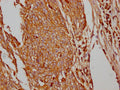 IHC image of CSB-RA297401A0HU diluted at 1:100 and staining in paraffin-embedded human cervical cancer performed on a Leica BondTM system. After dewaxing and hydration, antigen retrieval was mediated by high pressure in a citrate buffer (pH 6.0) . Section was blocked with 10% normal goat serum 30min at RT. Then primary antibody (1% BSA) was incubated at 4℃ overnight. The primary is detected by a Goat anti-rabbit IgG polymer labeled by HRP and visualized using 0.05% DAB.