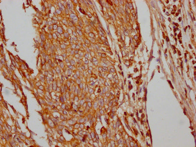 IHC image of CSB-RA297401A0HU diluted at 1:100 and staining in paraffin-embedded human cervical cancer performed on a Leica BondTM system. After dewaxing and hydration, antigen retrieval was mediated by high pressure in a citrate buffer (pH 6.0) . Section was blocked with 10% normal goat serum 30min at RT. Then primary antibody (1% BSA) was incubated at 4℃ overnight. The primary is detected by a Goat anti-rabbit IgG polymer labeled by HRP and visualized using 0.05% DAB.