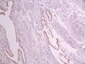 IHC image of CSB-RA342667A0HU diluted at 1:100 and staining in paraffin-embedded human cervical cancer performed on a Leica BondTM system. After dewaxing and hydration, antigen retrieval was mediated by high pressure in a citrate buffer (pH 6.0) . Section was blocked with 10% normal goat serum 30min at RT. Then primary antibody (1% BSA) was incubated at 4°C overnight. The primary is detected by a Goat anti-rabbit polymer IgG labeled by HRP and visualized using 0.05% DAB.