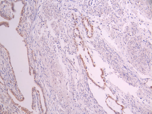 IHC image of CSB-RA342667A0HU diluted at 1:100 and staining in paraffin-embedded human cervical cancer performed on a Leica BondTM system. After dewaxing and hydration, antigen retrieval was mediated by high pressure in a citrate buffer (pH 6.0) . Section was blocked with 10% normal goat serum 30min at RT. Then primary antibody (1% BSA) was incubated at 4°C overnight. The primary is detected by a Goat anti-rabbit polymer IgG labeled by HRP and visualized using 0.05% DAB.