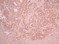 IHC image of CSB-RA360437MA1HU diluted at 1:50 and staining in paraffin-embedded human prostate cancer performed on a Leica BondTM system. After dewaxing and hydration, antigen retrieval was mediated by high pressure in a citrate buffer (pH 6.0). Section was blocked with 10% normal goat serum 30min at RT. Then primary antibody (1% BSA) was incubated at 4°C overnight. The primary is detected by a Anti-Human lgG, Fcy Fragment Specific labeled by HRP and visualized using 0.05% DAB.
