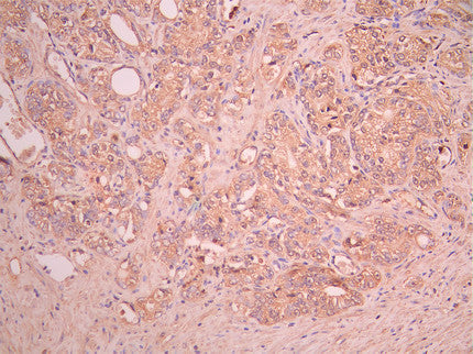 IHC image of CSB-RA360437MA1HU diluted at 1:50 and staining in paraffin-embedded human prostate cancer performed on a Leica BondTM system. After dewaxing and hydration, antigen retrieval was mediated by high pressure in a citrate buffer (pH 6.0). Section was blocked with 10% normal goat serum 30min at RT. Then primary antibody (1% BSA) was incubated at 4°C overnight. The primary is detected by a Anti-Human lgG, Fcy Fragment Specific labeled by HRP and visualized using 0.05% DAB.