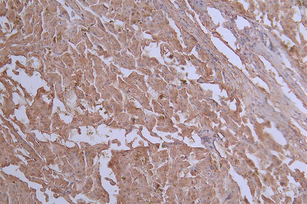 IHC image of CSB-RA438622A0HU diluted at 1:50 and staining in paraffin-embedded human liver cancer performed on a Leica BondTM system. After dewaxing and hydration, antigen retrieval was mediated by high pressure in a citrate buffer (pH 6.0) . Section was blocked with 10% normal goat serum 30min at RT. Then primary antibody (1% BSA) was incubated at 4°C overnight. The primary is detected by a Goat anti-rabbit polymer IgG labeled by HRP and visualized using 0.20% DAB.