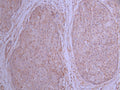 IHC image of CSB-RA439535A0HU diluted at 1:100 and staining in paraffin-embedded human pancreatic cancer performed on a Leica BondTM system. After dewaxing and hydration, antigen retrieval was mediated by high pressure in a citrate buffer (pH 6.0) . Section was blocked with 10% normal goat serum 30min at RT. Then primary antibody (1% BSA) was incubated at 4°C overnight. The primary is detected by a Goat anti-rabbit polymer IgG labeled by HRP and visualized using 0.05% DAB.