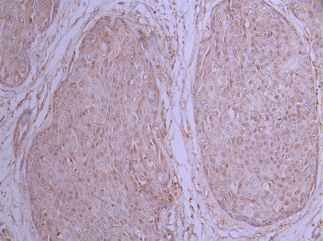 IHC image of CSB-RA439535A0HU diluted at 1:100 and staining in paraffin-embedded human pancreatic cancer performed on a Leica BondTM system. After dewaxing and hydration, antigen retrieval was mediated by high pressure in a citrate buffer (pH 6.0) . Section was blocked with 10% normal goat serum 30min at RT. Then primary antibody (1% BSA) was incubated at 4°C overnight. The primary is detected by a Goat anti-rabbit polymer IgG labeled by HRP and visualized using 0.05% DAB.