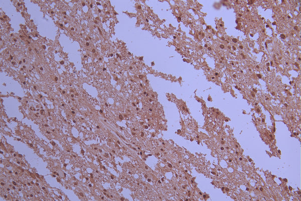 IHC image of CSB-RA439668A0HU diluted at 1:100 and staining in paraffin-embedded human glioma cancer performed on a Leica BondTM system. After dewaxing and hydration, antigen retrieval was mediated by high pressure in a citrate buffer (pH 6.0) . Section was blocked with 10% normal goat serum 30min at RT. Then primary antibody (1% BSA) was incubated at 4°C overnight. The primary is detected by a Goat anti-rabbit polymer IgG labeled by HRP and visualized using 0.05% DAB.