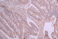 IHC image of CSB-RA440534A0HU diluted at 1:100 and staining in paraffin-embedded human colorectal cancer performed on a Leica BondTM system. After dewaxing and hydration, antigen retrieval was mediated by high pressure in a citrate buffer (pH 6.0) . Section was blocked with 10% normal goat serum 30min at RT. Then primary antibody (1% BSA) was incubated at 4°C overnight. The primary is detected by a Goat anti-rabbit polymer IgG labeled by HRP and visualized using 0.05% DAB.