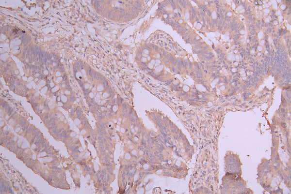 IHC image of CSB-RA440534A0HU diluted at 1:100 and staining in paraffin-embedded human colorectal cancer performed on a Leica BondTM system. After dewaxing and hydration, antigen retrieval was mediated by high pressure in a citrate buffer (pH 6.0) . Section was blocked with 10% normal goat serum 30min at RT. Then primary antibody (1% BSA) was incubated at 4°C overnight. The primary is detected by a Goat anti-rabbit polymer IgG labeled by HRP and visualized using 0.05% DAB.