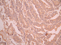 IHC image of CSB-RA441466A0HU diluted at 1:100 and staining in paraffin-embedded human colorectal cancer performed on a Leica BondTM system. After dewaxing and hydration, antigen retrieval was mediated by high pressure in a citrate buffer (pH 6.0). Section was blocked with 10% normal goat serum 30min at RT. Then primary antibody (1% BSA) was incubated at 4°C overnight. The primary is detected by a Goat anti-rabbit polymer IgG labeled by HRP and visualized using 0.05% DAB.
