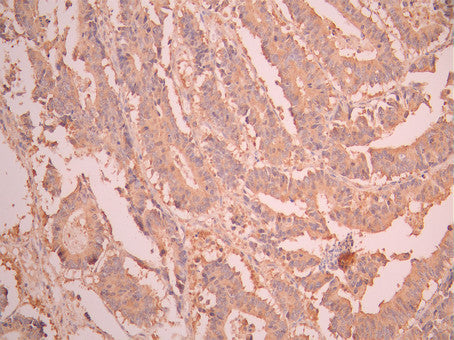 IHC image of CSB-RA441466A0HU diluted at 1:100 and staining in paraffin-embedded human colorectal cancer performed on a Leica BondTM system. After dewaxing and hydration, antigen retrieval was mediated by high pressure in a citrate buffer (pH 6.0). Section was blocked with 10% normal goat serum 30min at RT. Then primary antibody (1% BSA) was incubated at 4°C overnight. The primary is detected by a Goat anti-rabbit polymer IgG labeled by HRP and visualized using 0.05% DAB.