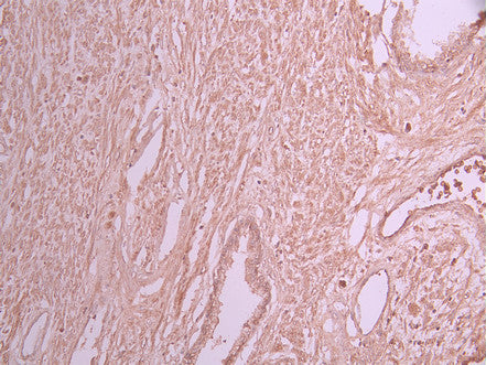 IHC image of CSB-RA445470A0HU diluted at 1:100 and staining in paraffin-embedded human prostate cancer performed on a Leica BondTM system. After dewaxing and hydration, antigen retrieval was mediated by high pressure in a citrate buffer (pH 6.0) . Section was blocked with 10% normal goat serum 30min at RT. Then primary antibody (1% BSA) was incubated at 4°C overnight. The primary is detected by a Goat anti-rabbit polymer IgG labeled by HRP and visualized using 0.05% DAB.