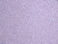 IHC image of CSB-RA448852A0HU diluted at 1:100 and staining in paraffin-embedded human liver cancer performed on a Leica BondTM system. After dewaxing and hydration, antigen retrieval was mediated by high pressure in a citrate buffer (pH 6.0) . Section was blocked with 10% normal goat serum 30min at RT. Then primary antibody (1% BSA) was incubated at 4°C overnight. The primary is detected by a Goat anti-rabbit polymer IgG labeled by HRP and visualized using 0.05% DAB.