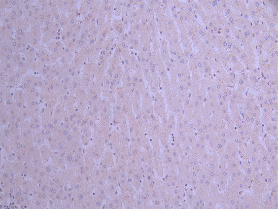 IHC image of CSB-RA448852A0HU diluted at 1:100 and staining in paraffin-embedded human liver cancer performed on a Leica BondTM system. After dewaxing and hydration, antigen retrieval was mediated by high pressure in a citrate buffer (pH 6.0) . Section was blocked with 10% normal goat serum 30min at RT. Then primary antibody (1% BSA) was incubated at 4°C overnight. The primary is detected by a Goat anti-rabbit polymer IgG labeled by HRP and visualized using 0.05% DAB.
