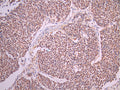 IHC image of CSB-RA449123A0HU diluted at 1:100 and staining in paraffin-embedded human lung cancer performed on a Leica BondTM system. After dewaxing and hydration, antigen retrieval was mediated by high pressure in a citrate buffer (pH 6.0). Section was blocked with 10% normal goat serum 30min at RT. Then primary antibody (1% BSA) was incubated at 4°C overnight. The primary is detected by a Goat anti-rabbit polymer IgG labeled by HRP and visualized using 0.05% DAB.