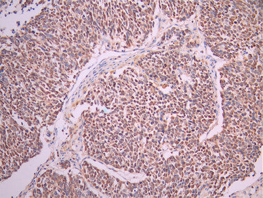 IHC image of CSB-RA449123A0HU diluted at 1:100 and staining in paraffin-embedded human lung cancer performed on a Leica BondTM system. After dewaxing and hydration, antigen retrieval was mediated by high pressure in a citrate buffer (pH 6.0). Section was blocked with 10% normal goat serum 30min at RT. Then primary antibody (1% BSA) was incubated at 4°C overnight. The primary is detected by a Goat anti-rabbit polymer IgG labeled by HRP and visualized using 0.05% DAB.