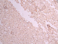IHC image of CSB-RA449438A0HU diluted at 1:100 and staining in paraffin-embedded human glioma cancer performed on a Leica BondTM system. After dewaxing and hydration, antigen retrieval was mediated by high pressure in a citrate buffer (pH 6.0) . Section was blocked with 10% normal goat serum 30min at RT. Then primary antibody (1% BSA) was incubated at 4°C overnight. The primary is detected by a Goat anti-rabbit polymer IgG labeled by HRP and visualized using 0.05% DAB.
