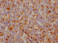 IHC image of CSB-RA449834A0HU diluted at 1:100 and staining in paraffin-embedded human breast cancer performed on a Leica BondTM system. After dewaxing and hydration, antigen retrieval was mediated by high pressure in a citrate buffer (pH 6.0) . Section was blocked with 10% normal goat serum 30min at RT. Then primary antibody (1% BSA) was incubated at 4℃ overnight. The primary is detected by a Goat anti-rabbit IgG polymer labeled by HRP and visualized using 0.05% DAB.