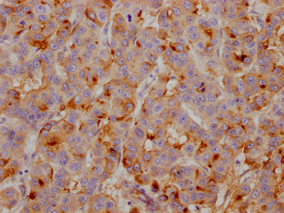 IHC image of CSB-RA449834A0HU diluted at 1:100 and staining in paraffin-embedded human breast cancer performed on a Leica BondTM system. After dewaxing and hydration, antigen retrieval was mediated by high pressure in a citrate buffer (pH 6.0) . Section was blocked with 10% normal goat serum 30min at RT. Then primary antibody (1% BSA) was incubated at 4℃ overnight. The primary is detected by a Goat anti-rabbit IgG polymer labeled by HRP and visualized using 0.05% DAB.