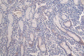IHC image of CSB-RA547773A0HU diluted at 1:100 and staining in paraffin-embedded human breast cancer performed on a Leica BondTM system. After dewaxing and hydration, antigen retrieval was mediated by high pressure in a citrate buffer (pH 6.0) . Section was blocked with 10% normal goat serum 30min at RT. Then primary antibody (1% BSA) was incubated at 4°C overnight. The primary is detected by a Goat anti-rabbit polymer IgG labeled by HRP and visualized using 0.07% DAB.