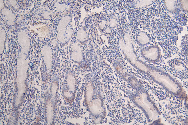 IHC image of CSB-RA547773A0HU diluted at 1:100 and staining in paraffin-embedded human breast cancer performed on a Leica BondTM system. After dewaxing and hydration, antigen retrieval was mediated by high pressure in a citrate buffer (pH 6.0) . Section was blocked with 10% normal goat serum 30min at RT. Then primary antibody (1% BSA) was incubated at 4°C overnight. The primary is detected by a Goat anti-rabbit polymer IgG labeled by HRP and visualized using 0.07% DAB.