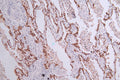 IHC image of CSB-RA548145A0HU diluted at 1:50 and staining in paraffin-embedded human lung cancer performed on a Leica BondTM system. After dewaxing and hydration, antigen retrieval was mediated by high pressure in a citrate buffer (pH 6.0) . Section was blocked with 10% normal goat serum 30min at RT. Then primary antibody (1% BSA) was incubated at 4°C overnight. The primary is detected by a Goat anti-rabbit polymer IgG labeled by HRP and visualized using 0.33% DAB.