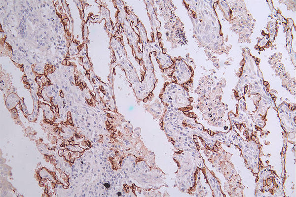 IHC image of CSB-RA548145A0HU diluted at 1:50 and staining in paraffin-embedded human lung cancer performed on a Leica BondTM system. After dewaxing and hydration, antigen retrieval was mediated by high pressure in a citrate buffer (pH 6.0) . Section was blocked with 10% normal goat serum 30min at RT. Then primary antibody (1% BSA) was incubated at 4°C overnight. The primary is detected by a Goat anti-rabbit polymer IgG labeled by HRP and visualized using 0.33% DAB.