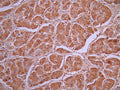 IHC image of CSB-RA548433A0HU diluted at 1:100 and staining in paraffin-embedded human liver cancer performed on a Leica BondTM system. After dewaxing and hydration, antigen retrieval was mediated by high pressure in a citrate buffer (pH 6.0). Section was blocked with 10% normal goat serum 30min at RT. Then primary antibody (1% BSA) was incubated at 4°C overnight. The primary is detected by a Goat anti-rabbit polymer IgG labeled by HRP and visualized using 0.05% DAB.