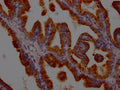 IHC image of CSB-RA548583A0HU diluted at 1:100 and staining in paraffin-embedded human prostate tissue performed on a Leica BondTM system. After dewaxing and hydration, antigen retrieval was mediated by high pressure in a citrate buffer (pH 6.0) . Section was blocked with 10% normal goat serum 30min at RT. Then primary antibody (1% BSA) was incubated at 4℃ overnight. The primary is detected by a Goat anti-rabbit IgG polymer labeled by HRP and visualized using 0.05% DAB.