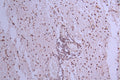 IHC image of CSB-RA549049A0HU diluted at 1:100 and staining in paraffin-embedded human glioma cancer performed on a Leica BondTM system. After dewaxing and hydration, antigen retrieval was mediated by high pressure in a citrate buffer (pH 6.0) . Section was blocked with 10% normal goat serum 30min at RT. Then primary antibody (1% BSA) was incubated at 4°C overnight. The primary is detected by a Goat anti-rabbit polymer IgG labeled by HRP and visualized using 0.05% DAB.