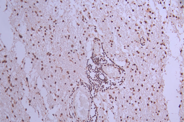IHC image of CSB-RA549049A0HU diluted at 1:100 and staining in paraffin-embedded human glioma cancer performed on a Leica BondTM system. After dewaxing and hydration, antigen retrieval was mediated by high pressure in a citrate buffer (pH 6.0) . Section was blocked with 10% normal goat serum 30min at RT. Then primary antibody (1% BSA) was incubated at 4°C overnight. The primary is detected by a Goat anti-rabbit polymer IgG labeled by HRP and visualized using 0.05% DAB.