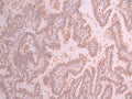 IHC image of CSB-RA551654A0HU diluted at 1:100 and staining in paraffin-embedded human lung cancer performed on a Leica BondTM system. After dewaxing and hydration, antigen retrieval was mediated by high pressure in a citrate buffer (pH 6.0) . Section was blocked with 10% normal goat serum 30min at RT. Then primary antibody (1% BSA) was incubated at 4°C overnight. The primary is detected by a Goat anti-rabbit polymer IgG labeled by HRP and visualized using 0.05% DAB.