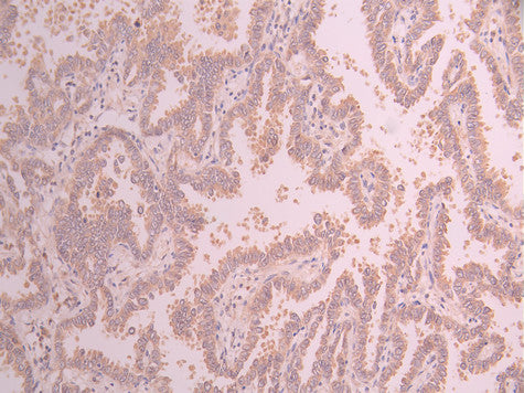 IHC image of CSB-RA551654A0HU diluted at 1:100 and staining in paraffin-embedded human lung cancer performed on a Leica BondTM system. After dewaxing and hydration, antigen retrieval was mediated by high pressure in a citrate buffer (pH 6.0) . Section was blocked with 10% normal goat serum 30min at RT. Then primary antibody (1% BSA) was incubated at 4°C overnight. The primary is detected by a Goat anti-rabbit polymer IgG labeled by HRP and visualized using 0.05% DAB.