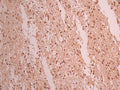 IHC image of CSB-RA552120A0HU diluted at 1:100 and staining in paraffin-embedded human glioma cancer performed on a Leica BondTM system. After dewaxing and hydration, antigen retrieval was mediated by high pressure in a citrate buffer (pH 6.0) . Section was blocked with 10% normal goat serum 30min at RT. Then primary antibody (1% BSA) was incubated at 4°C overnight. The primary is detected by a Goat anti-rabbit polymer IgG labeled by HRP and visualized using 0.05% DAB.