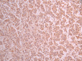 IHC image of CSB-RA562580A0HU diluted at 1:100 and staining in paraffin-embedded human breast cancer performed on a Leica BondTM system. After dewaxing and hydration, antigen retrieval was mediated by high pressure in a citrate buffer (pH 6.0) . Section was blocked with 10% normal goat serum 30min at RT. Then primary antibody (1% BSA) was incubated at 4°C overnight. The primary is detected by a Goat anti-rabbit polymer IgG labeled by HRP and visualized using 0.05% DAB.