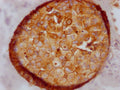 IHC image of CSB-RA576116A0HU diluted at 1:100 and staining in paraffin-embedded human breast cancer performed on a Leica BondTM system. After dewaxing and hydration, antigen retrieval was mediated by high pressure in a citrate buffer (pH 6.0) . Section was blocked with 10% normal goat serum 30min at RT. Then primary antibody (1% BSA) was incubated at 4℃ overnight. The primary is detected by a Goat anti-rabbit IgG polymer labeled by HRP and visualized using 0.05% DAB.