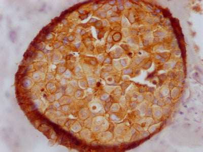 IHC image of CSB-RA576116A0HU diluted at 1:100 and staining in paraffin-embedded human breast cancer performed on a Leica BondTM system. After dewaxing and hydration, antigen retrieval was mediated by high pressure in a citrate buffer (pH 6.0) . Section was blocked with 10% normal goat serum 30min at RT. Then primary antibody (1% BSA) was incubated at 4℃ overnight. The primary is detected by a Goat anti-rabbit IgG polymer labeled by HRP and visualized using 0.05% DAB.