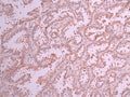 IHC image of CSB-RA579787A0HU diluted at 1:100 and staining in paraffin-embedded human lung cancer performed on a Leica BondTM system. After dewaxing and hydration, antigen retrieval was mediated by high pressure in a citrate buffer (pH 6.0) . Section was blocked with 10% normal goat serum 30min at RT. Then primary antibody (1% BSA) was incubated at 4°C overnight. The primary is detected by a Goat anti-rabbit polymer IgG labeled by HRP and visualized using 0.05% DAB.